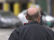 Tout savoir sur la greffe des cheveux