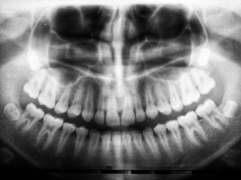 Dent fracturée causes, symptômes et traitements d'une dent fissurée — free download
