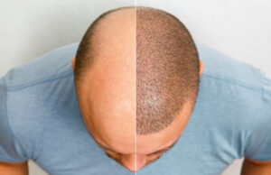 implant capillaire