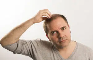 remédier à la calvitie