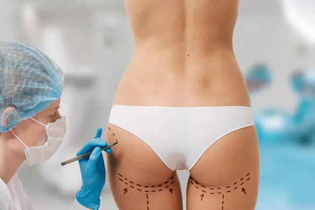 lipofilling fessier lipofilling fessier