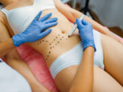 abdominoplastie