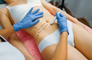 abdominoplastie